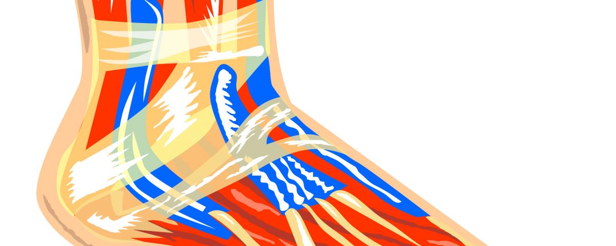 What is Plantar Fasciitis