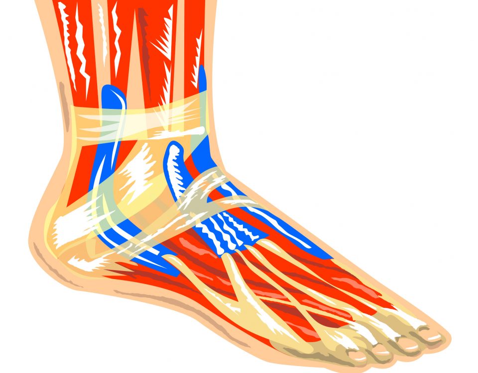 What is Plantar Fasciitis