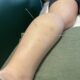 Dry Needling Sydney