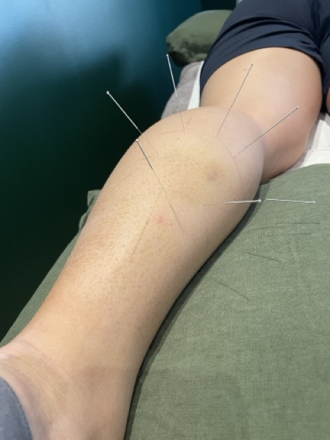 Dry Needling Sydney